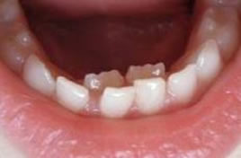 krzywe zęby u dzieci