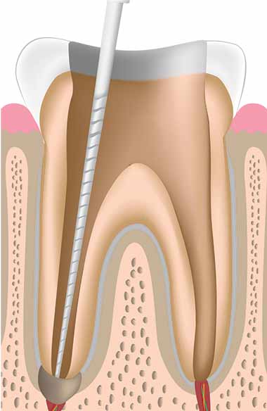 opracowywanie kanałów zębowych