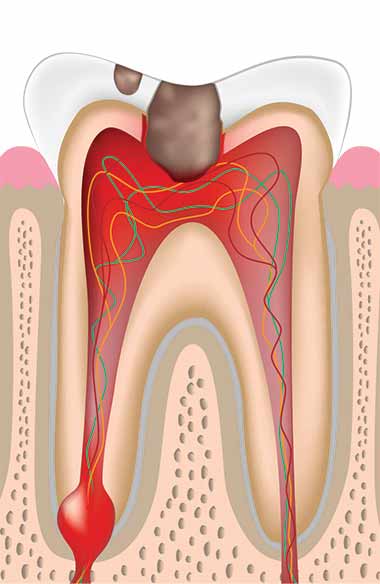 choroby miazgi zęba